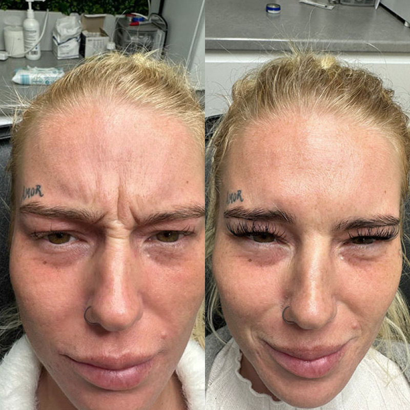 Female Anti Wrinkle treatments from 6 Clinic
